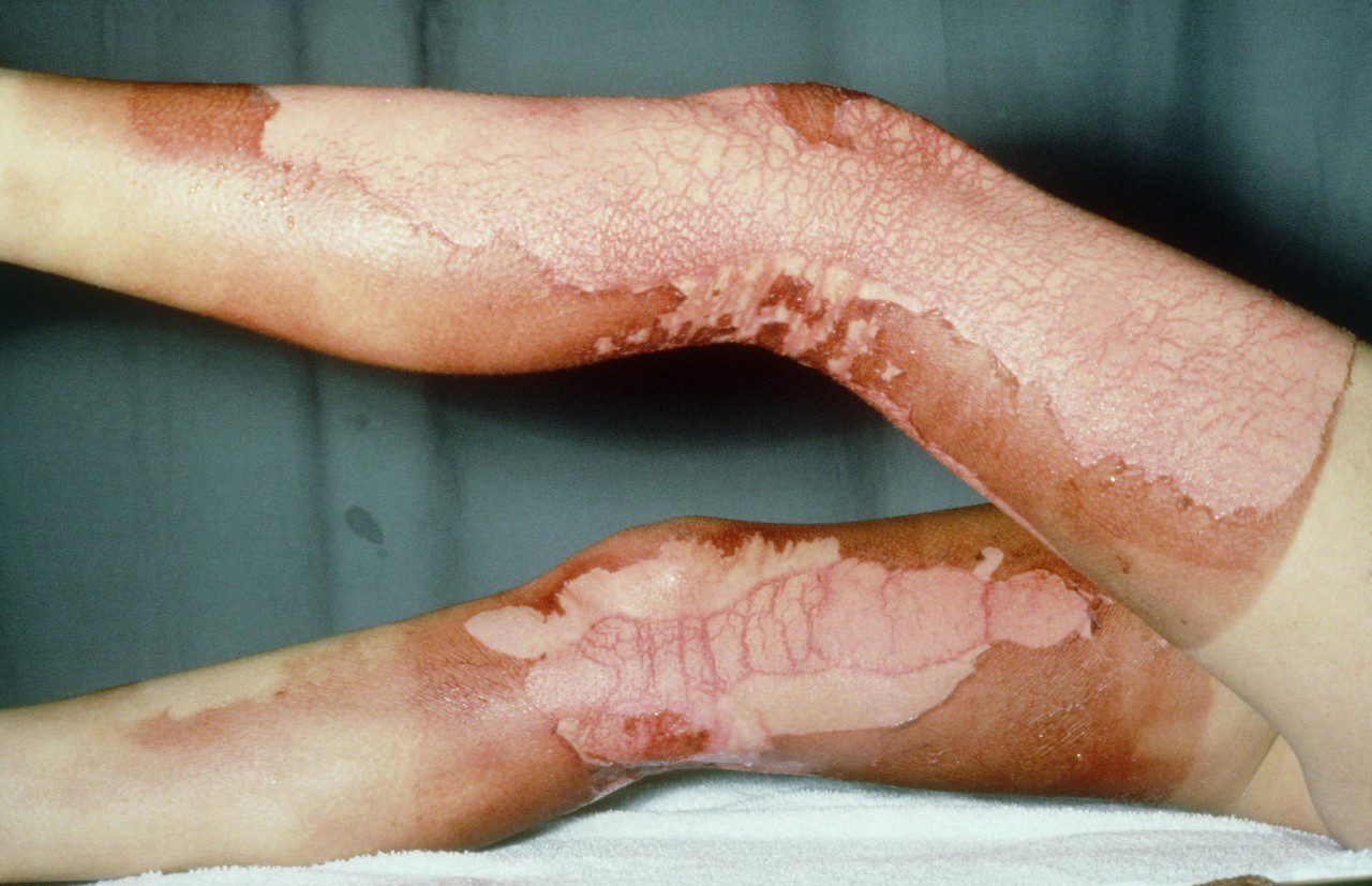 烧伤后疤痕增生如何预防